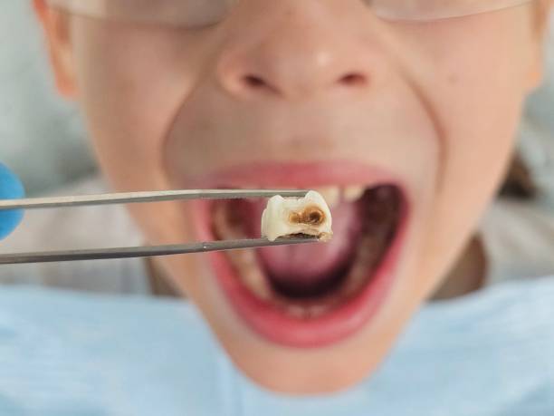 Best Emergency Tooth Extraction in Dixon Lane Meadow Creek, CA